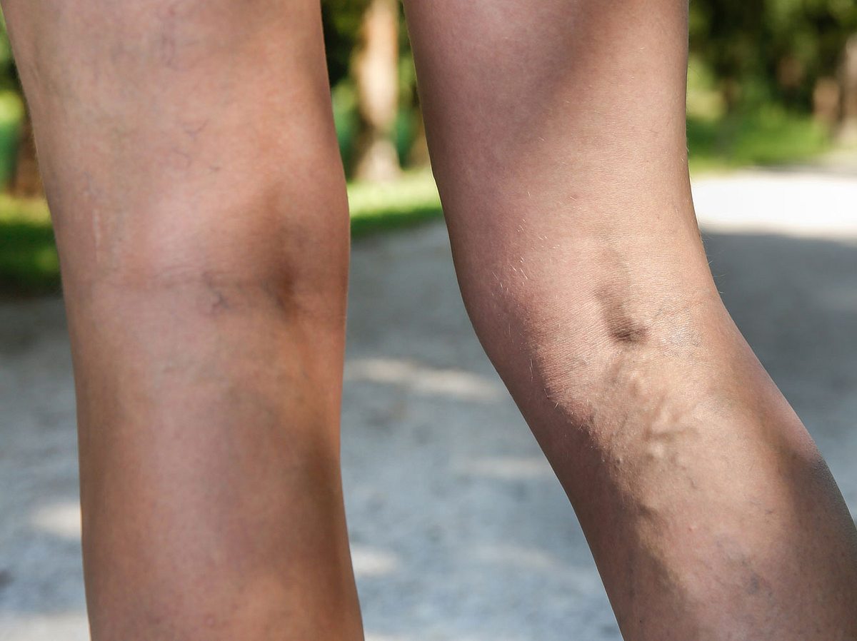 Arteriosklerose: Der Infarkt im Bein
