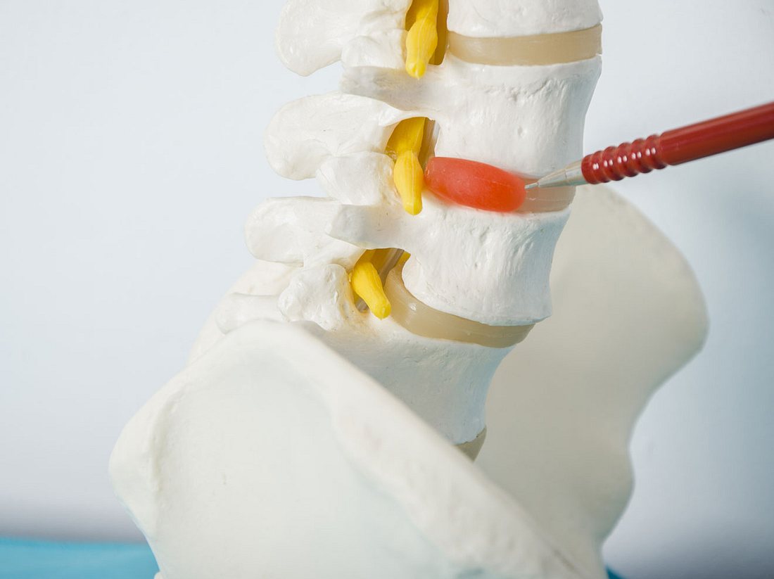 Gel-Implantat für kaputte Bandscheiben Gel-Implantat für kaputte Bandscheiben
