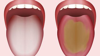 Eine belegte Zunge kann viel über Ihre Gesundheit aussagen. - Foto: PeterHermesFurian / iStock