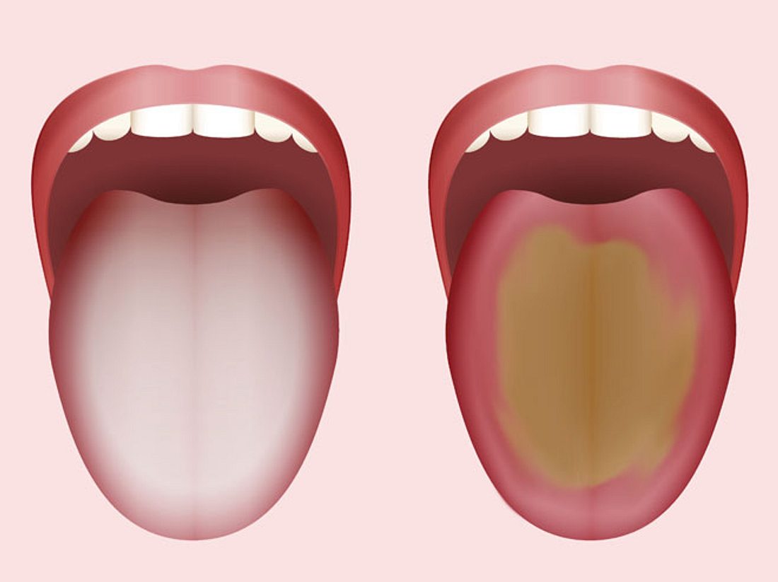 Zungenbelag brauner Belegte Zunge