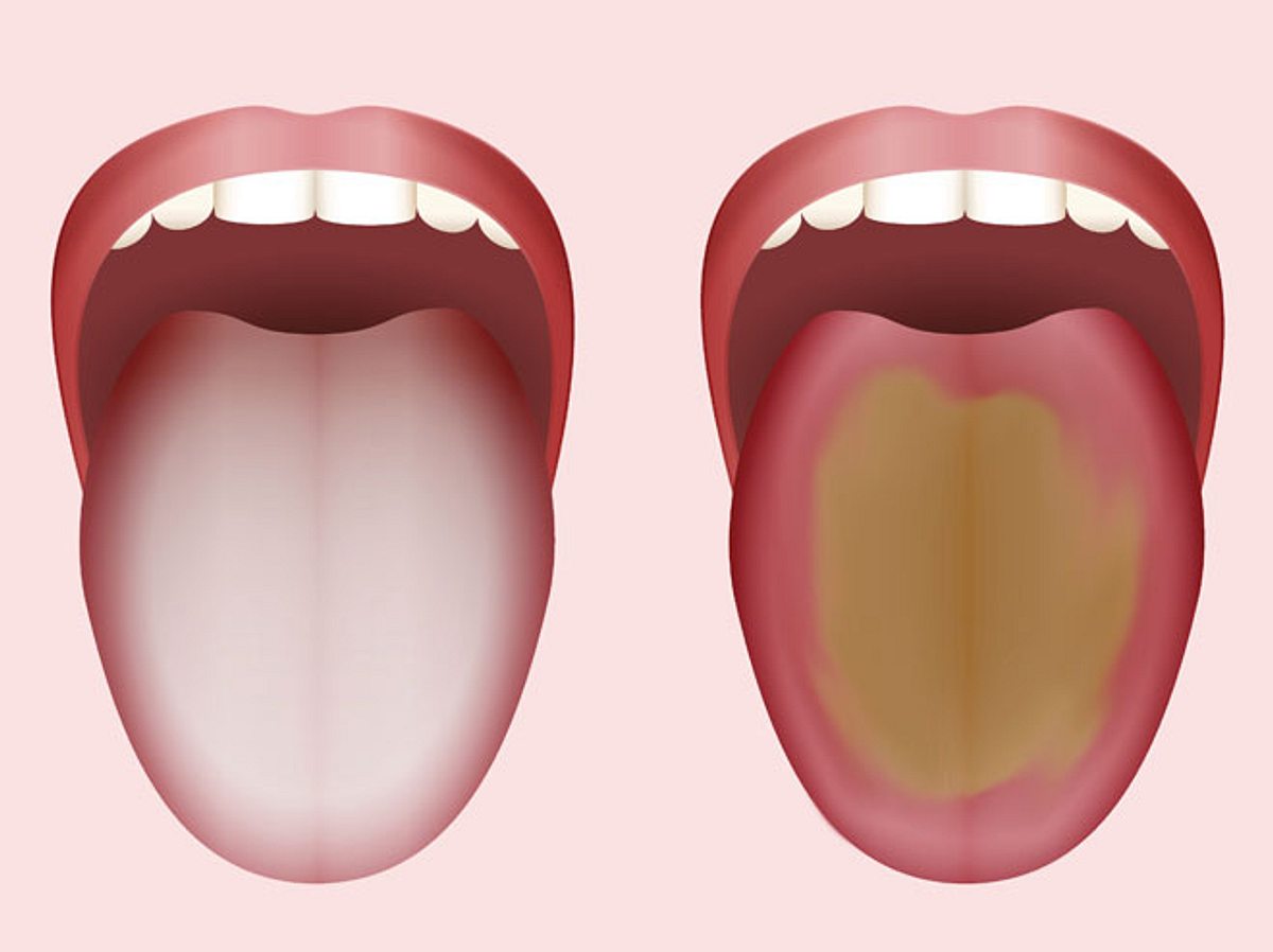 Eine belegte Zunge kann viel über Ihre Gesundheit aussagen.
