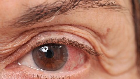 Gerötetes Auge einer Frau. - Foto: LeventKonuk / iStock