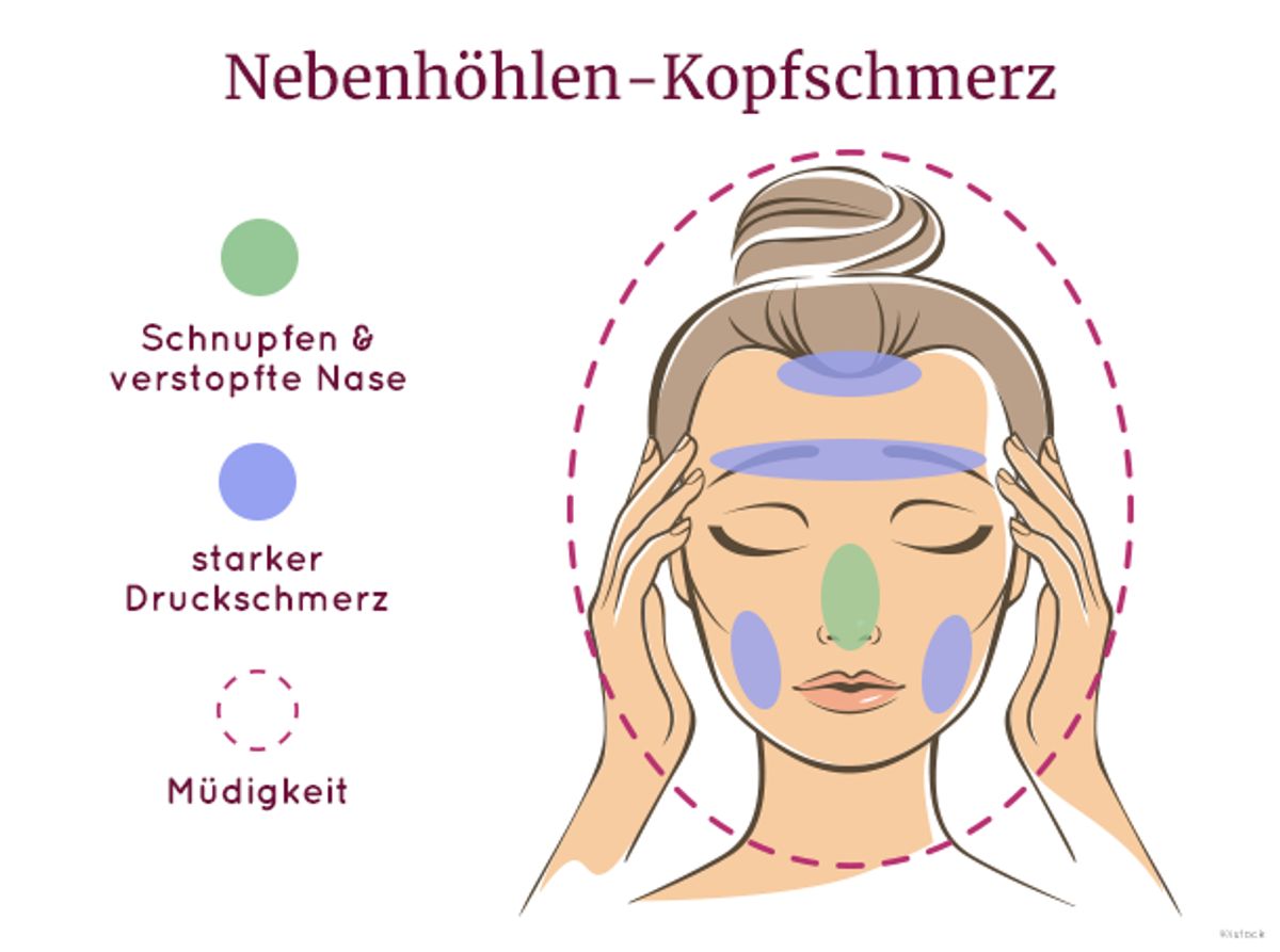 Sinus-Kopfschmerz, auch Nebenhöhlen-Kopfschmerz genannt.