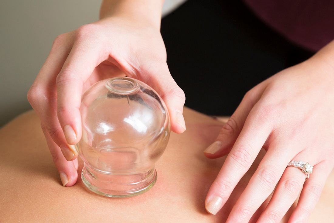 Cupping: So funktioniert das neue Schröpfen Cupping: So funktioniert das neue Schröpfen