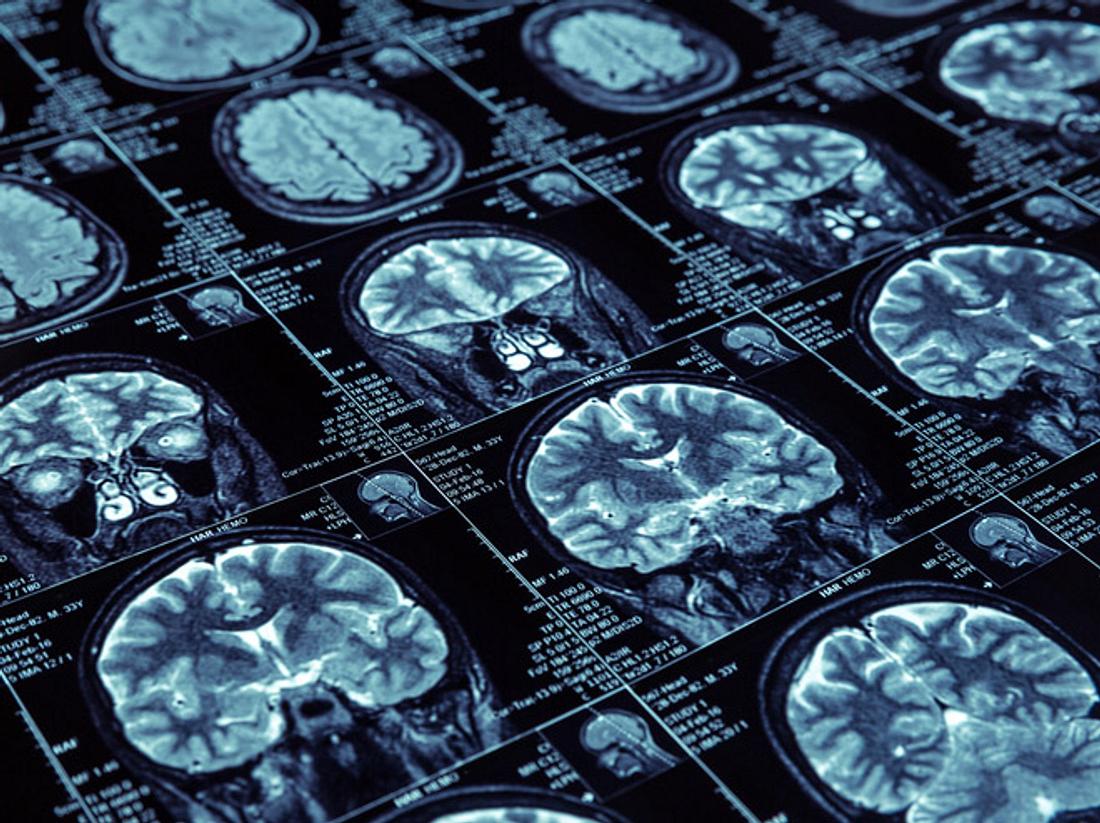 Forscher finden neue Substanz für Demenz-Therapie Forscher finden neue Substanz für Demenz-Therapie