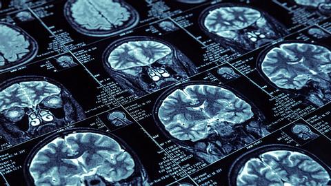 Forscher finden neue Substanz für Demenz-Therapie - Foto: Nomadsoul1 / iStock