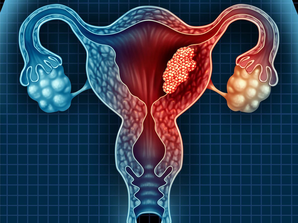 Gebärmutterkrebs erkennen und behandeln.