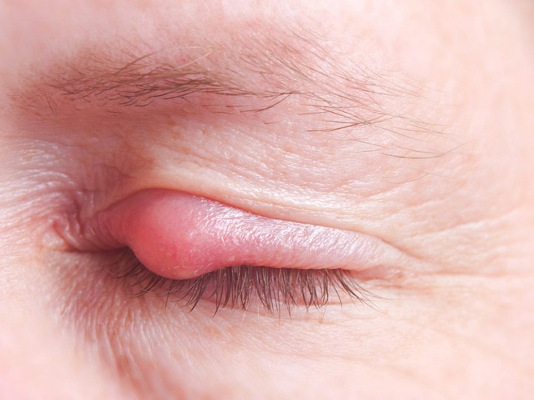 Gerstenkorn am Auge: Symptome und Behandlung