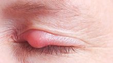 Gerstenkorn am Auge: Symptome und Behandlung - Foto: H_Barth / iStock