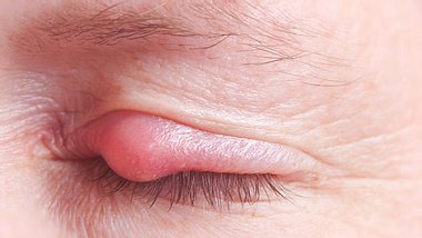 Gerstenkorn am Auge: Symptome und Behandlung - Foto: H_Barth / iStock