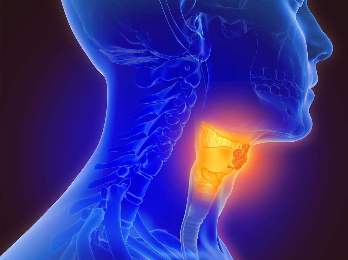 Kehlkopfkrebs erkennen und behandeln