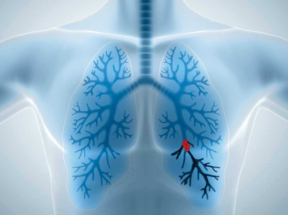 Lungenembolie erkennen und behandeln
