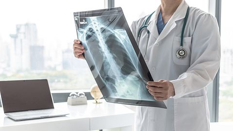 Arzt betrachtet Röntgenaufnahmen der Lungen. - Foto: Chinnapong / iStock