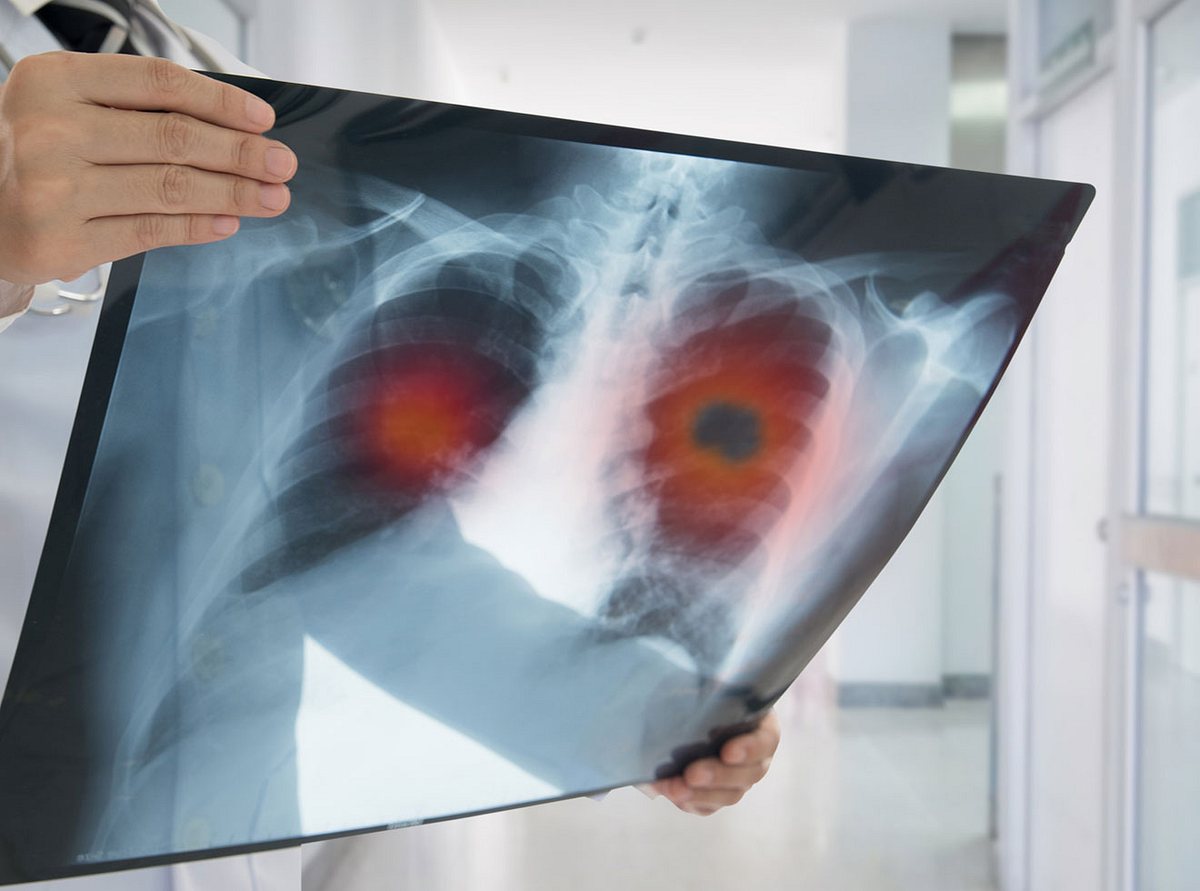 Welche Therapien bei Lungenkrebs angewendet werden und wie hoch die Heilungschancen sind. 