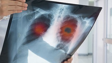 Welche Therapien bei Lungenkrebs angewendet werden und wie hoch die Heilungschancen sind.  - Foto: utah778 / iStock