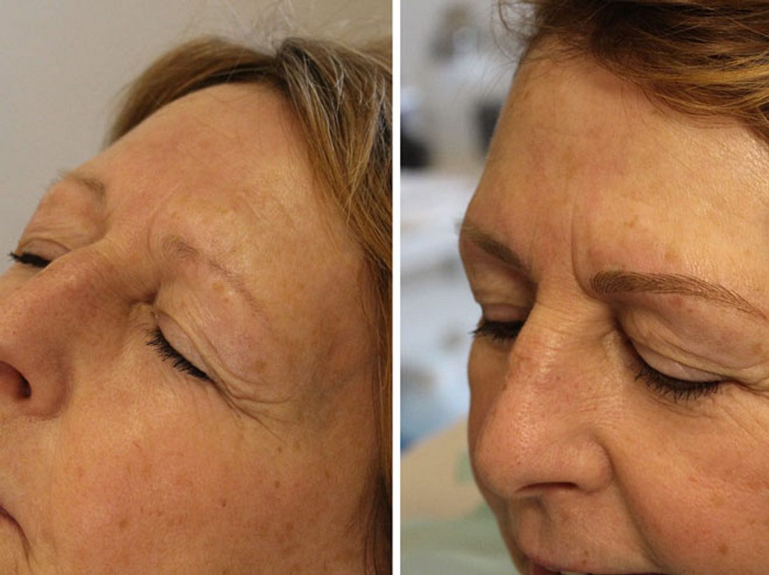 Links: vor der Behandlung. Rechts: das Ergebnis. Erfahrungsbericht vom Microblading: Der Vorher-Nachher-Vergleich