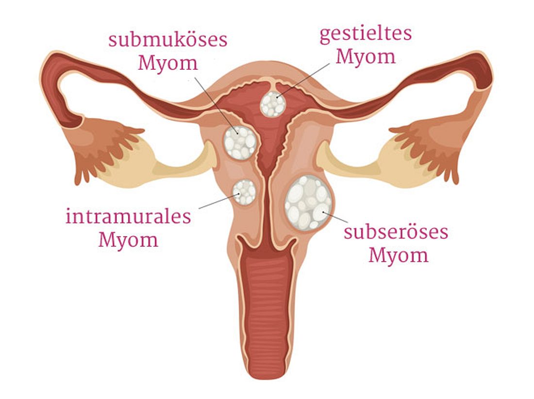 Myome: Das bedeutet die Diagnose Myome: Das bedeutet die Diagnose
