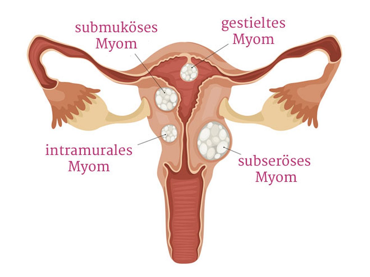 Myome: Das bedeutet die Diagnose 