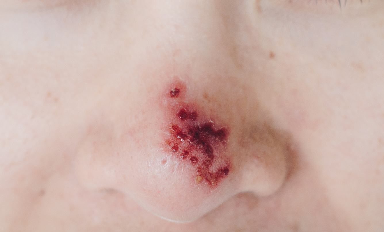 Großaufnahme einer weiblichen Nase, die von Nasenherpes befallen ist. 