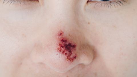 Großaufnahme einer weiblichen Nase, die von Nasenherpes befallen ist.  - Foto: Boyloso / iStock