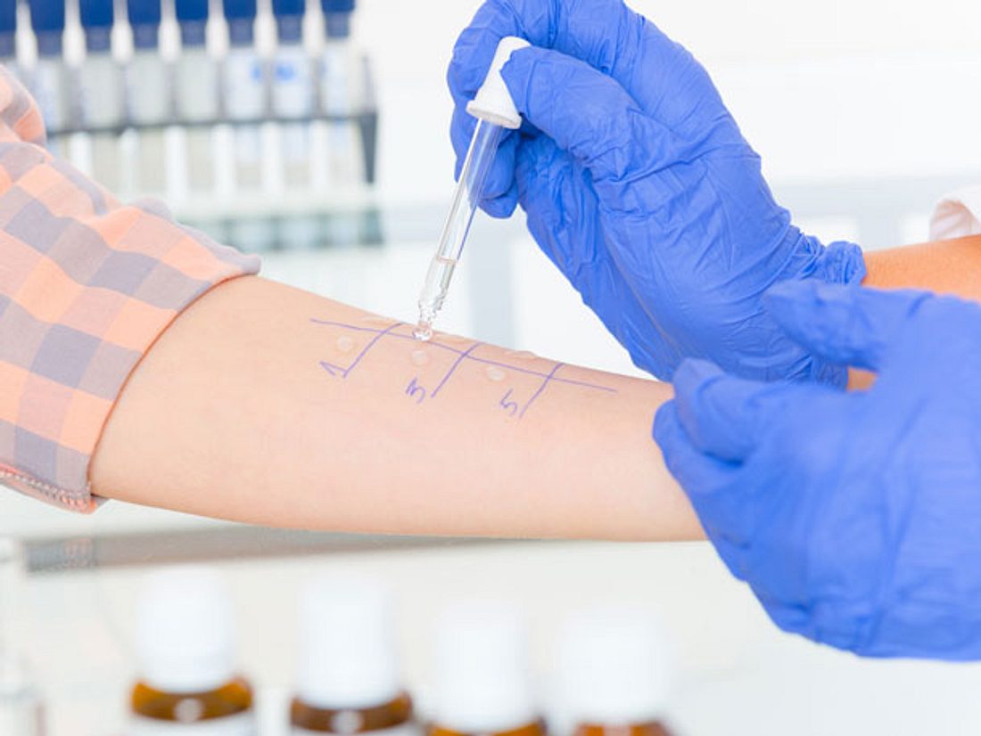 Pricktest beim Arzt: Auf der Innenseite des Unterarms wird markiert, an welcher
Stelle welcher Allergiestoff aufgetragen wird. Beim Pricktest werden die verdächtigen Pollen auf oder in die Haut eingebracht.
