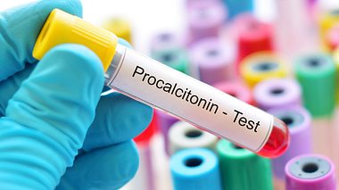 Procalcitonin-Test - Foto: jarun011 / iStock