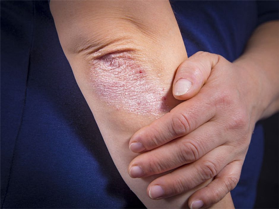 Welche Hiv Symptome Hattet Ihr