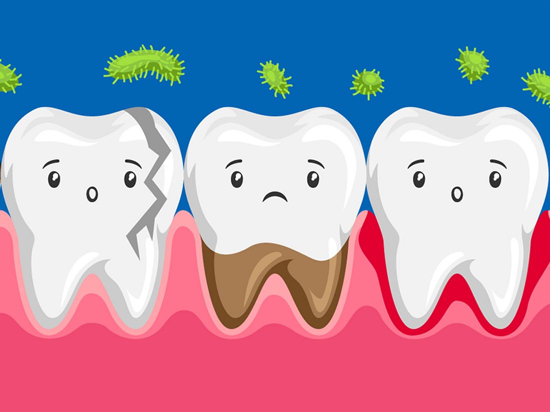 Sind schlechte Zähne vererbbar?