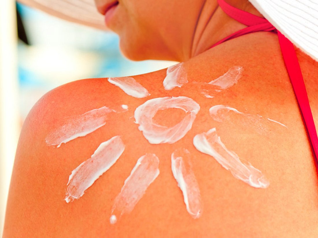 Was hilft gegen Sonnenbrand? Was hilft gegen Sonnenbrand?