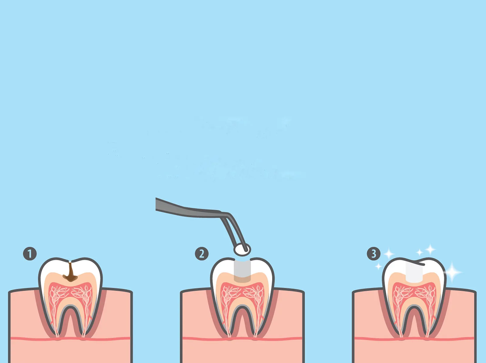 Welche Zahnfüllung ist für wen am besten?