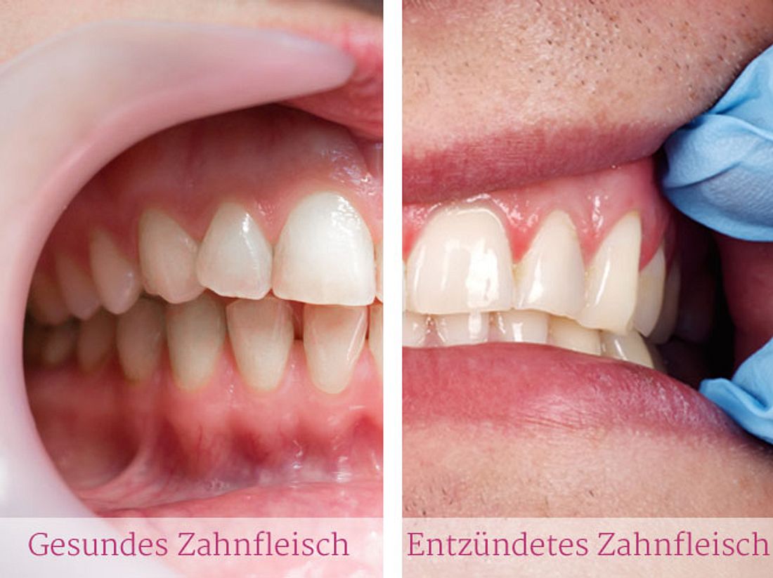 Links: gesundes Zahnfleisch. Rechts: gerötetes und angeschwollenes Zahnfleisch. Der Unterschied zwischen gesundem und entzündetem Zahnfleisch.