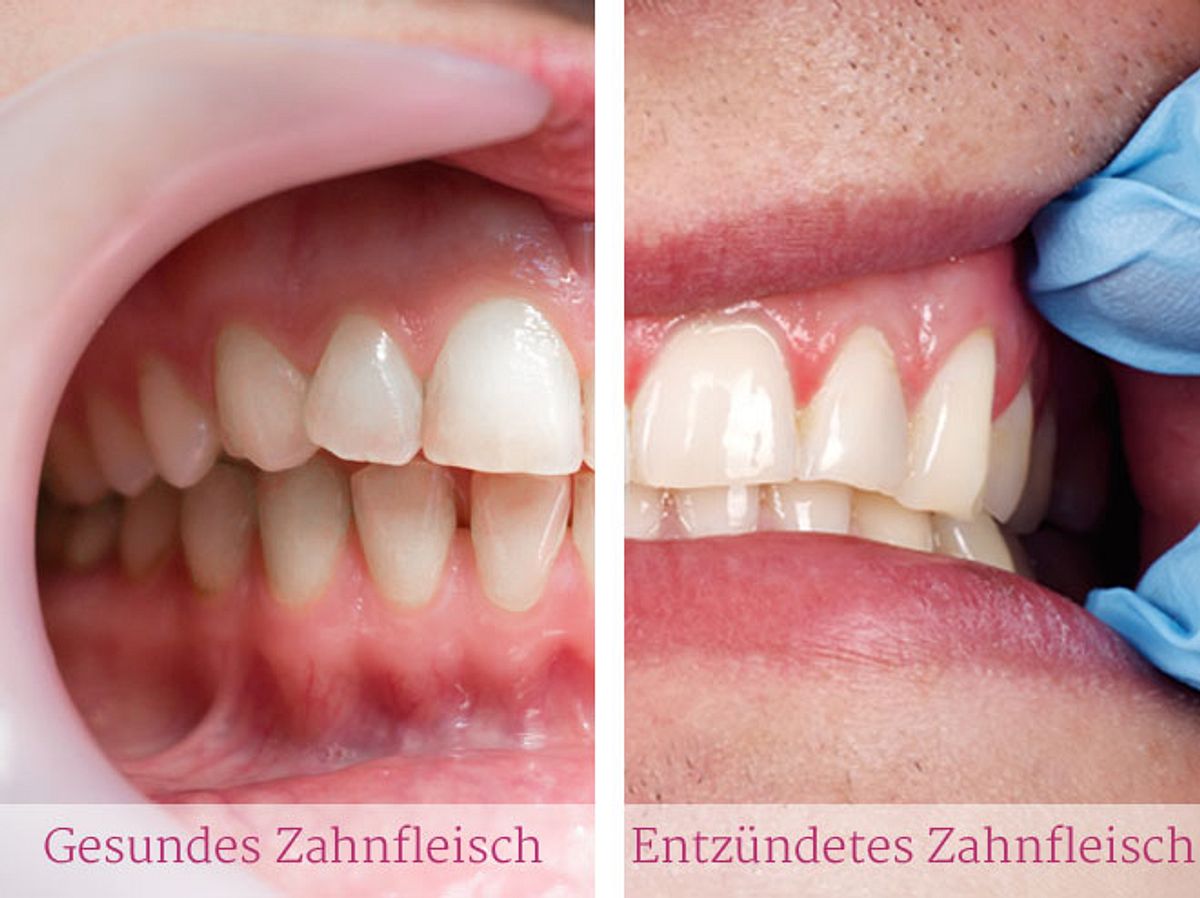 Der Unterschied zwischen gesundem und entzündetem Zahnfleisch.