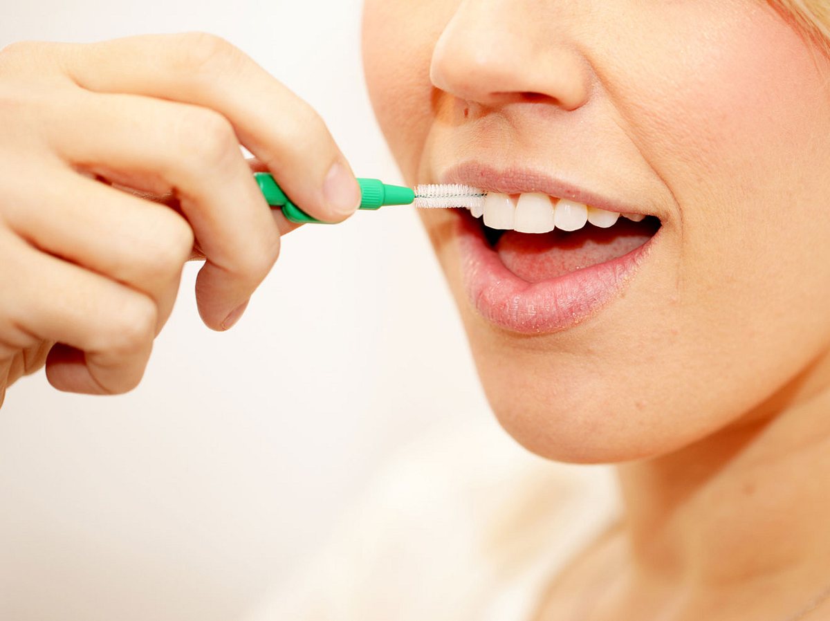 Zahnzwischenraumbürstchen können Zahnfleischentzündungen in den Zwischenräumen vorbeugen.